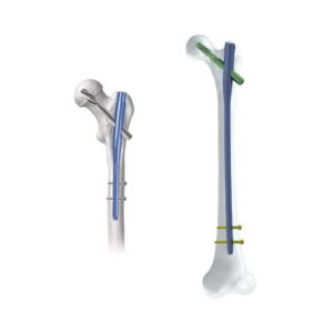 Femoral Head Gauge